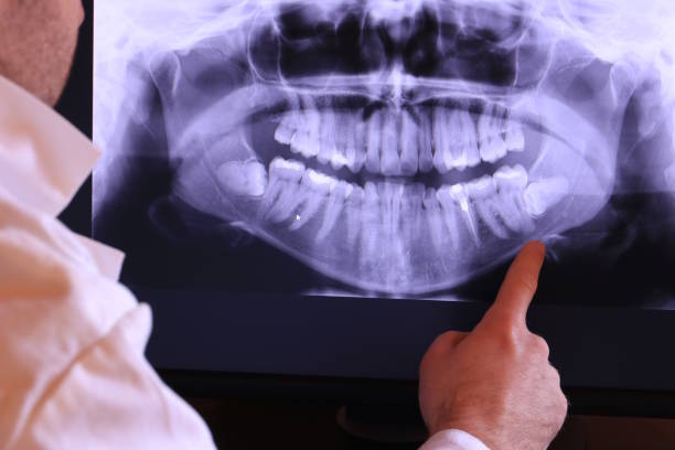 Best Emergency Dentist for Lost Fillings or Crowns in Bremen, GA